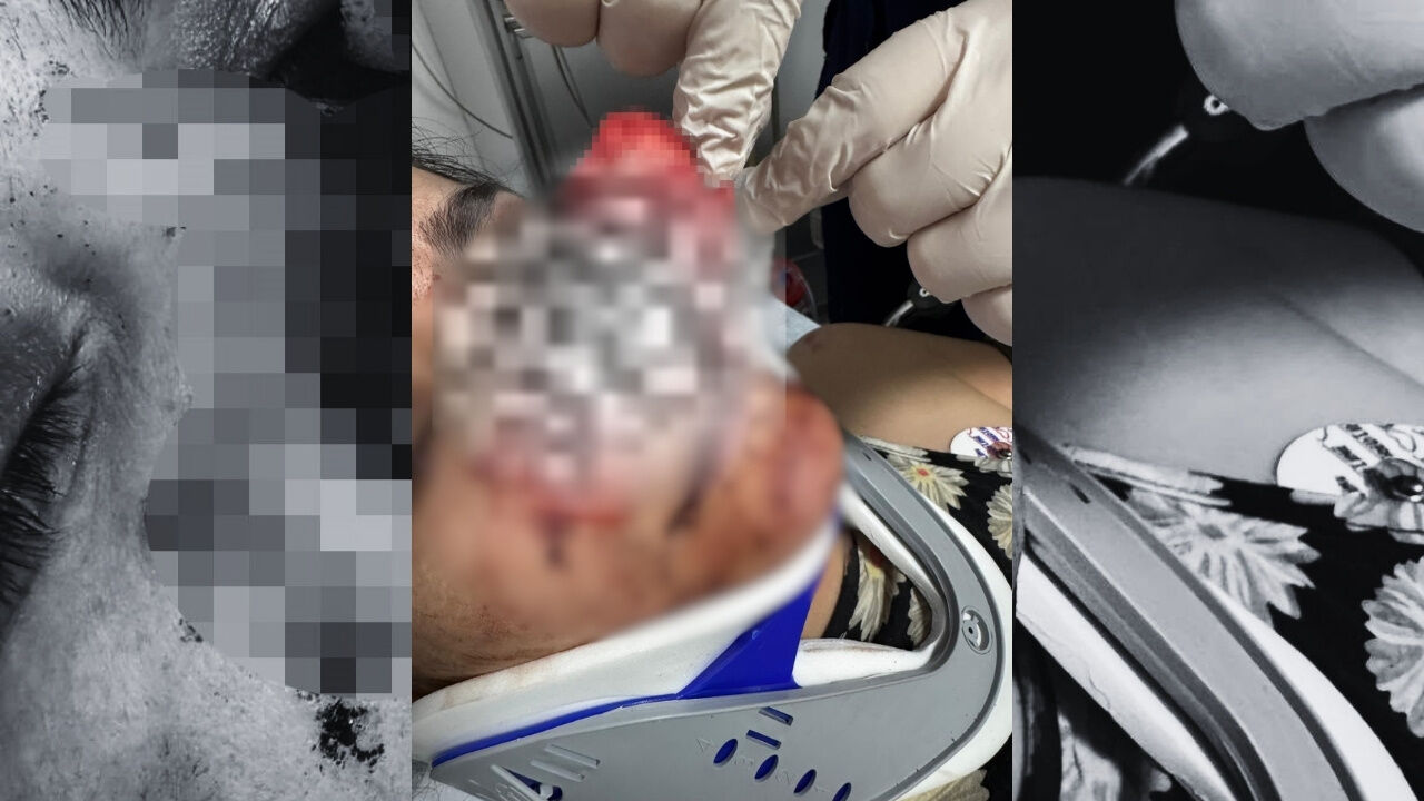 Manisa'da Eşi Burnunu Isırıp Koparmıştı Ameliyatla Yerine Dikildi 1